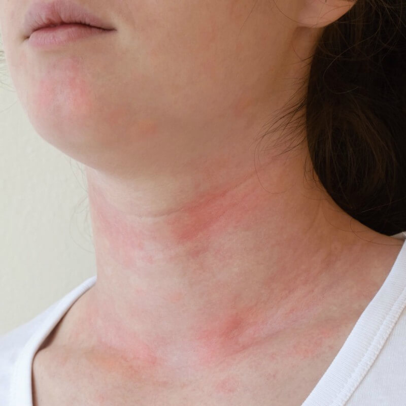 Dermatita de contact