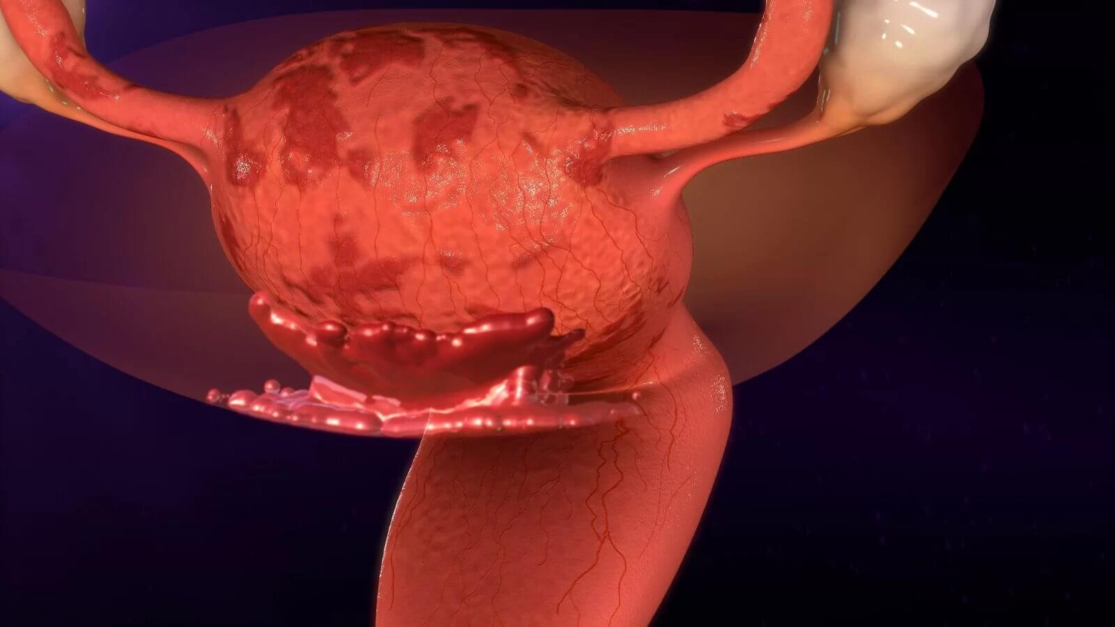 Endometrioza – Semne, simptome, cauze, tratament