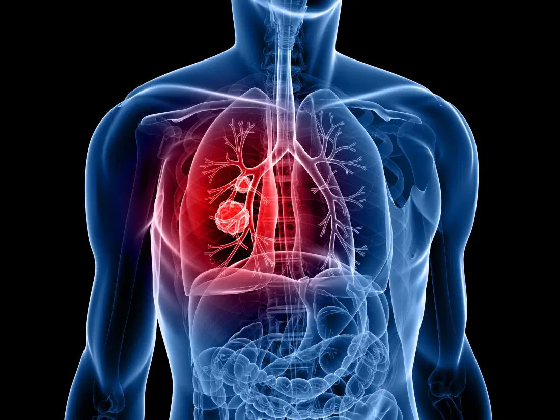 Cancer bronhopulmonar: Cauze, simptome si tratament